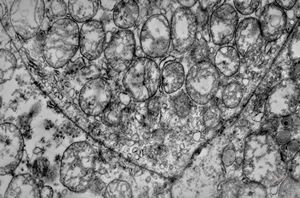 M,12y. | multiple mitochondria in oncocyte - Ewing sarcoma M,12y. | multiple mitochondria in oncocyte - Ewing sarcoma